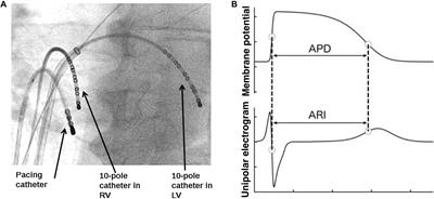 Complex Interaction Between Low-Frequency APD Oscillations and Beat-to-Beat APD Variability in Humans Is Governed by the Sympathetic Nervous System